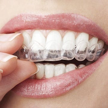 ClearCorrect clear aligners in Silver Spring, MD