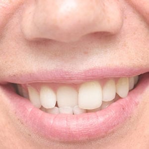 crooked teeth treatment in Silver Spring MD