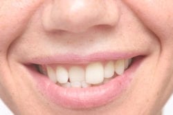 straighten crooked teeth without braces silver spring md
