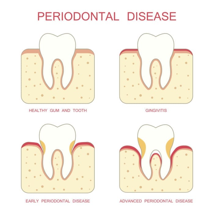 periodontal therapy in Silver Spring MD