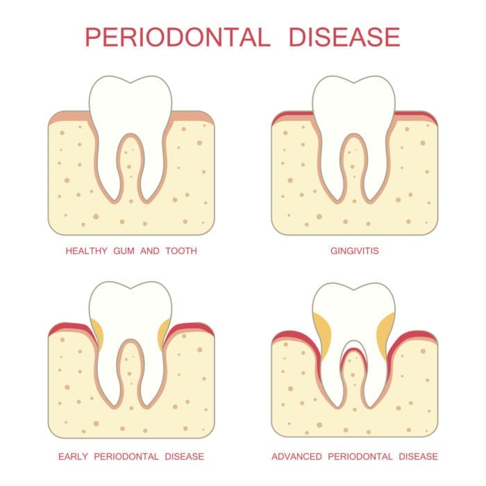 periodontal therapy in Silver Spring MD