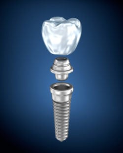 affordable mini implants and dental implants in Silver Spring