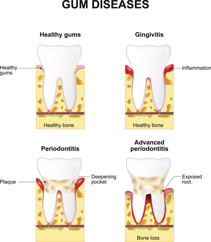 treatment for bleeding gums in silver spring, maryland