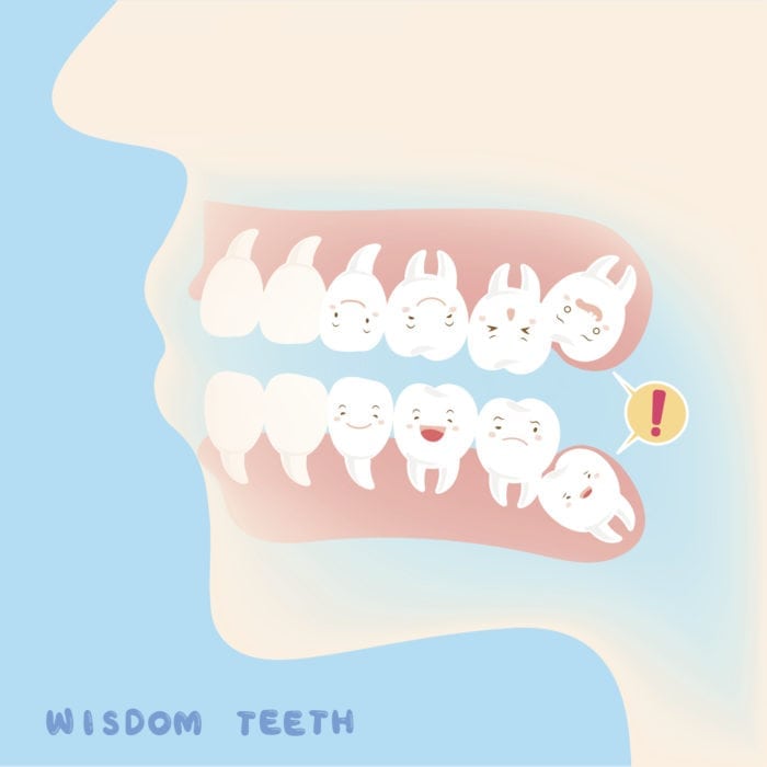 Silver Spring MD wisdom tooth removal
