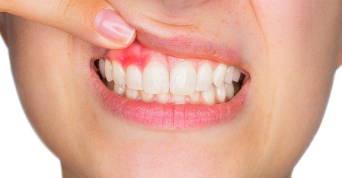 Gum Disease in Silver Spring MD