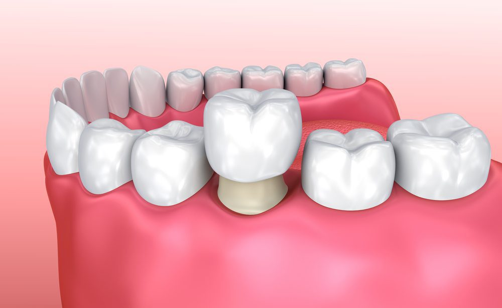 Dental crowns 