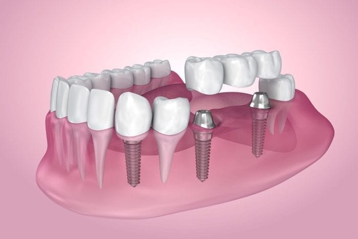 dental implants silver spring md