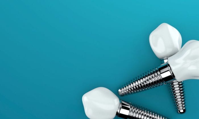 types of dental implants in Silver Spring Maryland