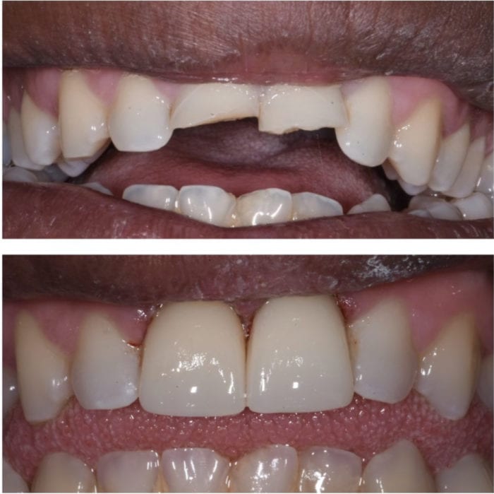 Before and after dental crowns in Silver Spring, Maryland