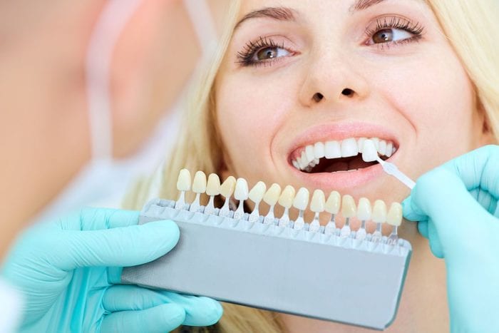 porcelain veneers aftercare in Silver Spring Maryland