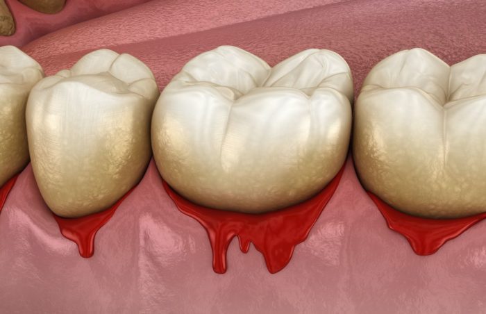 prevent periodontal disease in Silver Spring Maryland