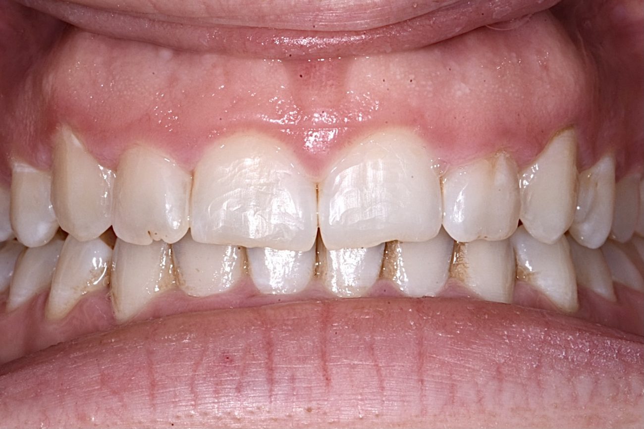 Silver Spring MD Cosmetic Dentistry Before & After Photos