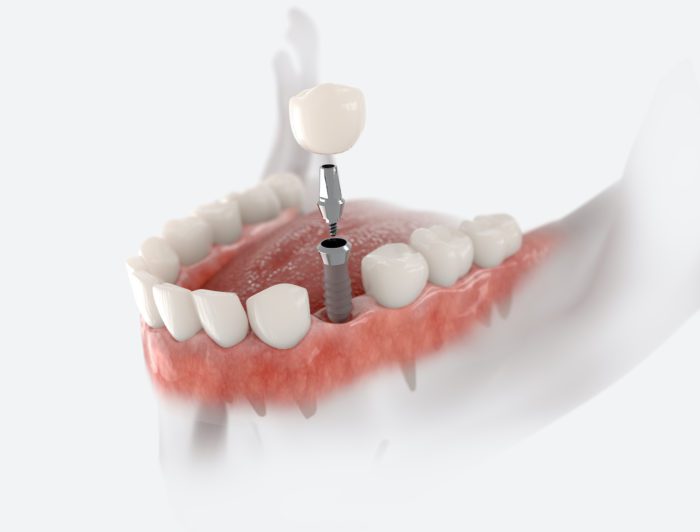 Dental implants mission viejo