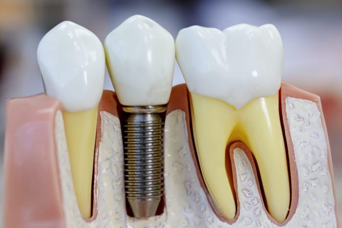 single dental implants in Silver Spring, Maryland