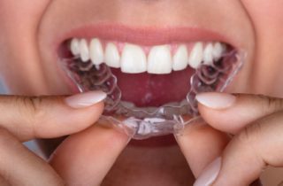 clear braces maintenance Silver Spring Maryland
