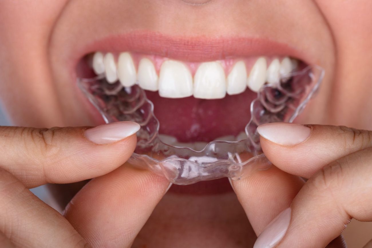 How to Keep Clear Aligners Clean - Silver Spring, MD Dentists