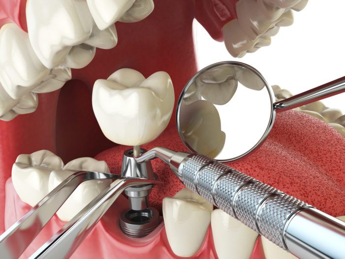 dental implant process in Silver Spring, Maryland