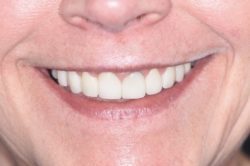 porcelain veneers treatment Silver Spring Maryland