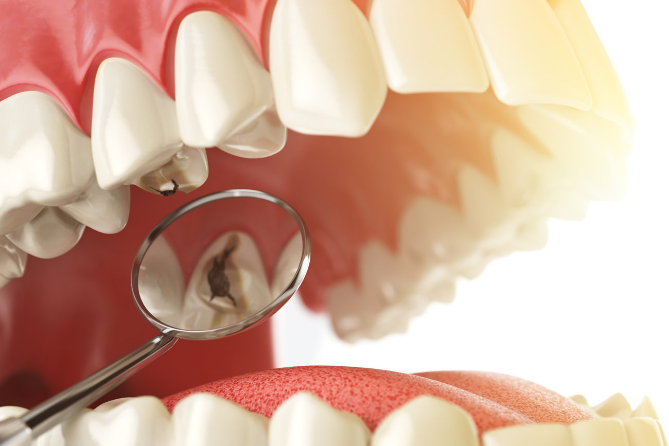 Tooth Decay Treatment in Silver Spring, MD Dental Fillings