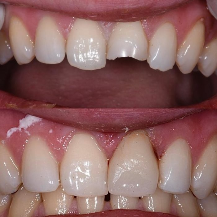 Tooth bonding for chipped front tooth