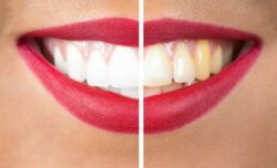 How Does Teeth Whitening Work