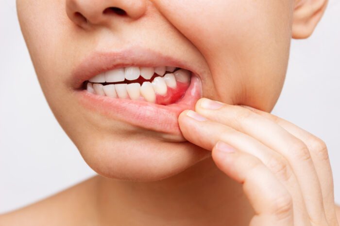 Bleeding Gums in Silver Spring MD