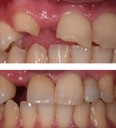 Before and After Same-Day Crown