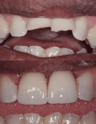Before and After Treating Broken Teeth