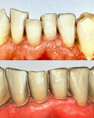 Before and After Crooked Teeth Treatment in Silver Spring MD