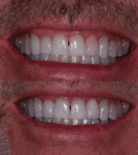 Before and After Tooth Discoloration Treatment in Silver Spring MD