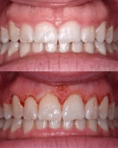 Before and after dental laser treatment