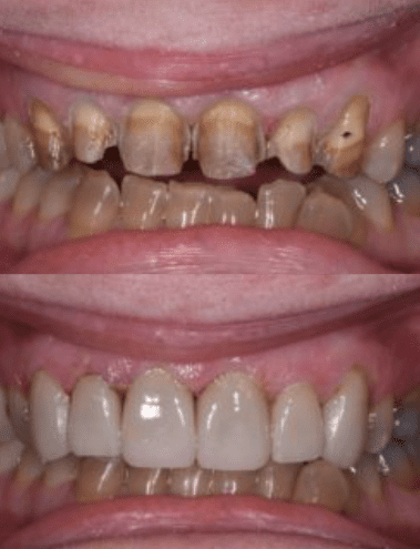 Before and after smile makeover