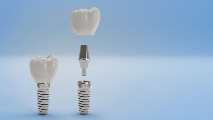 Dental Implant FAQs in Silver Spring MD