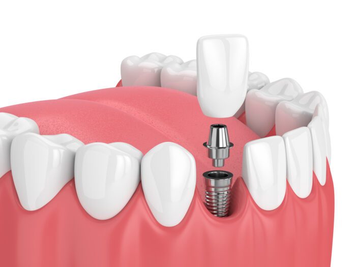 Single Dental Implant Treatment in Silver Spring
