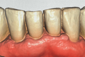 After photo showing the teeth prepared (filed down) for full coverage crowns to restore length and function.