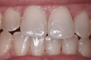 After photo showing the smile restored with new, natural-looking porcelain crowns or veneers.