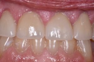After photo showing a refined, bright white smile with even tooth contours.
