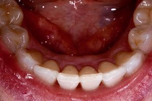 After photo showing the lower teeth straightened and aligned, likely with bonding or veneers.