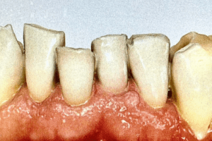 Before photo showing severe tooth wear, erosion, and yellowing of the upper front teeth.