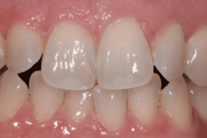 Before photo showing a smile with opaque, artificial-looking teeth (likely old crowns or bonding).