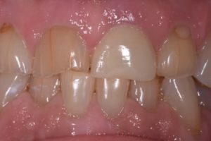 After photo showing the smile restored with new, natural-looking porcelain crowns or veneers.