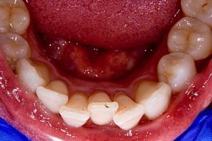 Before photo showing the lower front teeth with crowding and rotation.