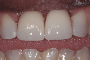 After photo showing the gap closed and teeth reshaped with dental bonding or veneers for a uniform smile.