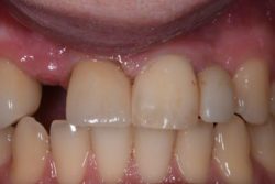After photo showing the restored lateral incisor and aligned teeth creating a symmetrical smile.