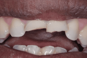 Before photo showing a smile with a visible gap (diastema) between the two upper front teeth.