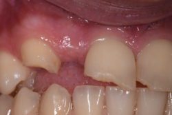 Before photo showing a smile with a missing or peg-shaped lateral incisor and minor crowding.