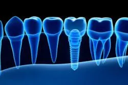 Digital illustration of a row of teeth in blue X-ray style, highlighting a dental implant screw integrated into the jawbone.