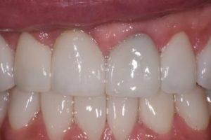 After photo showing a complete smile makeover with bright white, perfectly aligned porcelain veneers.