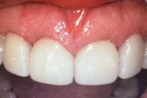 After photo showing the damaged tooth restored with a crown or veneer to match the natural smile.