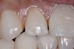 After photo showing the teeth restored with opaque, bright white porcelain veneers.